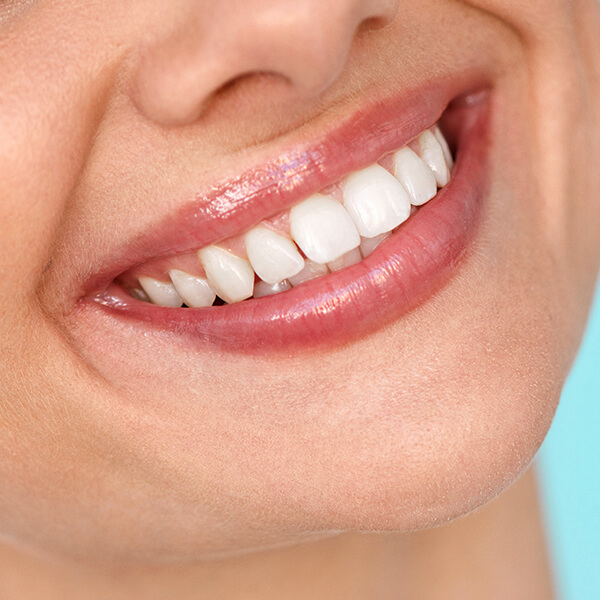 Veneers for Your Teeth in Sioux City IA Area