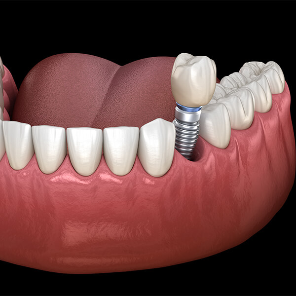 Dental Implants Near Me Sioux City IA Area